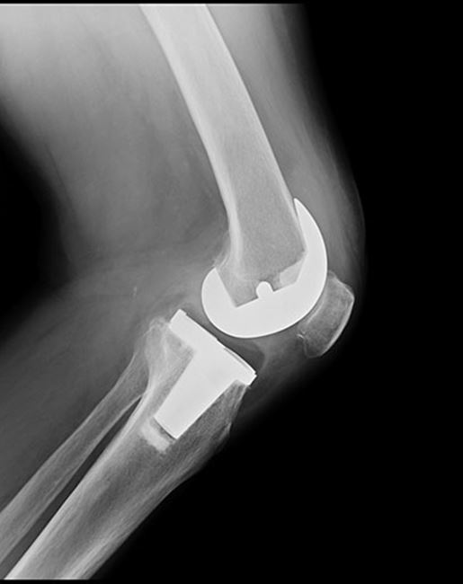 Bilateral Knee Replacement I Orthopaedics I St Vincent’s Private Hospitals